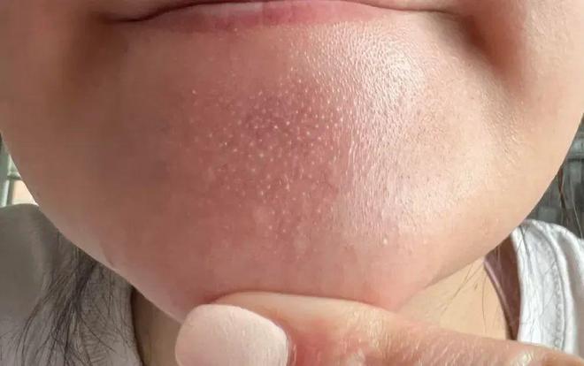 下巴凸起的小颗粒，到底是什么？