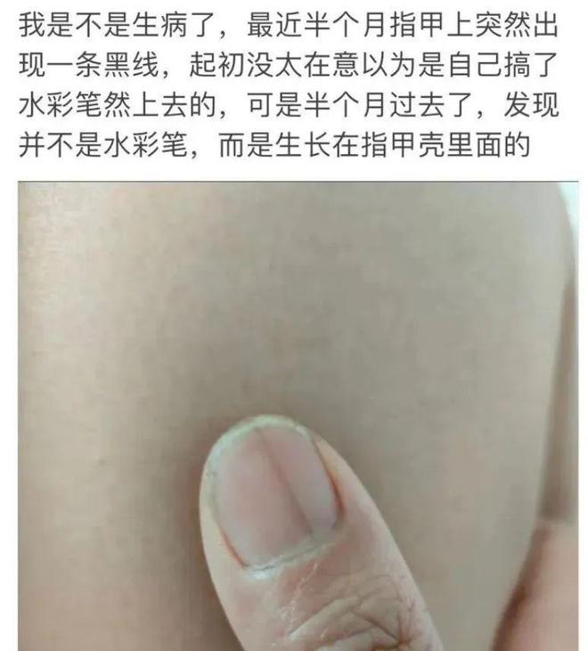 紧急提醒：指甲出现这种变化，可能是癌变信号！