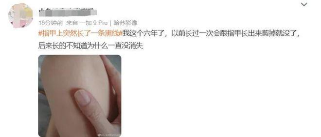 紧急提醒：指甲出现这种变化，可能是癌变信号！