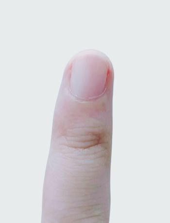 紧急提醒：指甲出现这种变化，可能是癌变信号！