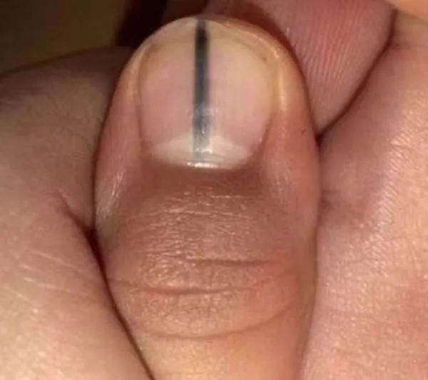 紧急提醒：指甲出现这种变化，可能是癌变信号！