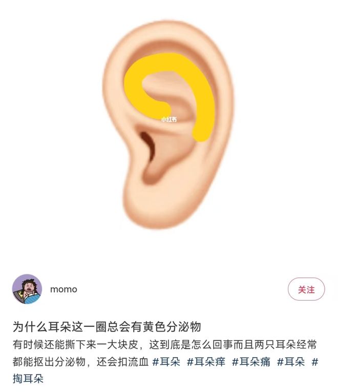 耳朵周围黄黄的分泌物，到底是什么？