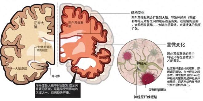 新研究揭示：7类食物为核心的饮食模式可预防痴呆
