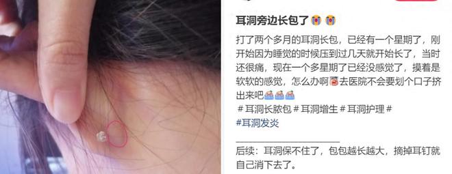 打耳洞后竟长肉疙瘩？真相曝光引热议
