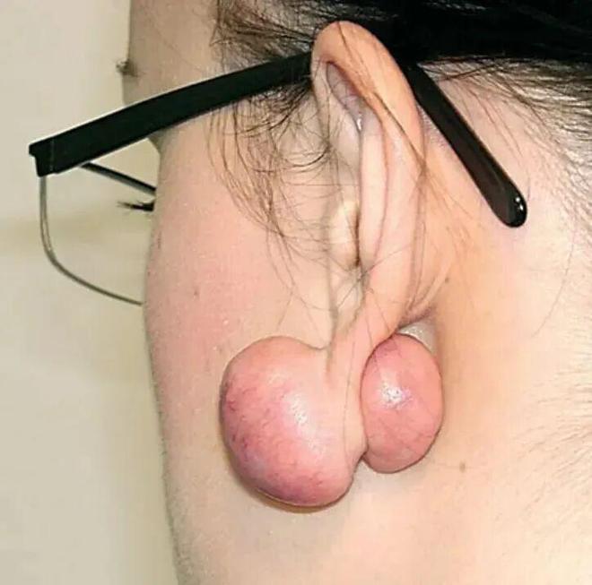 打耳洞后竟长肉疙瘩？真相曝光引热议