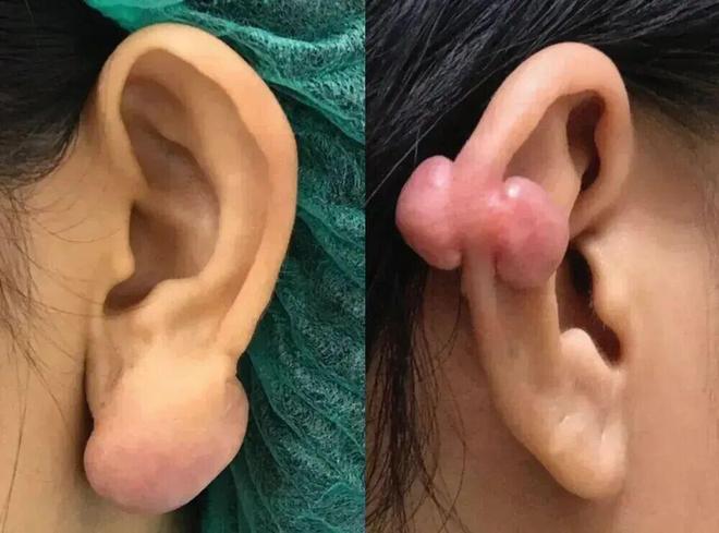 打耳洞后竟长肉疙瘩？真相曝光引热议