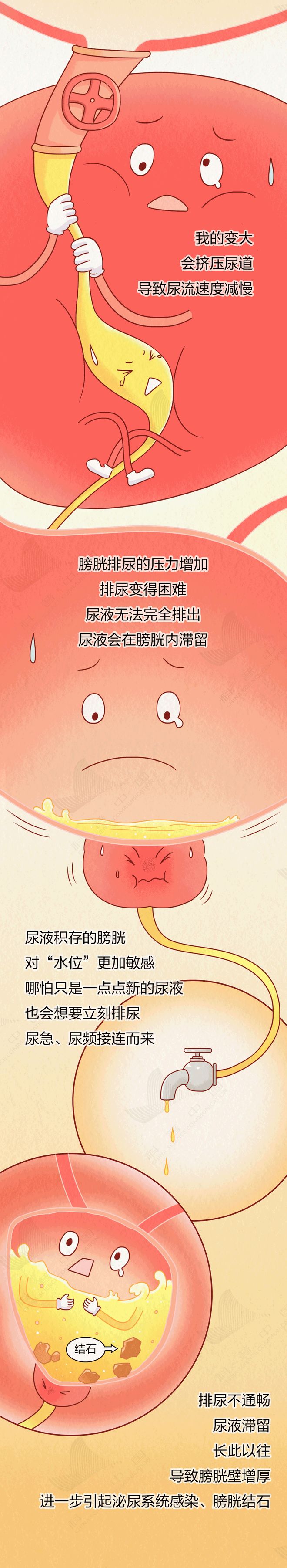 男人逃不掉的麻烦：前列腺变大！这5个习惯你可能也有