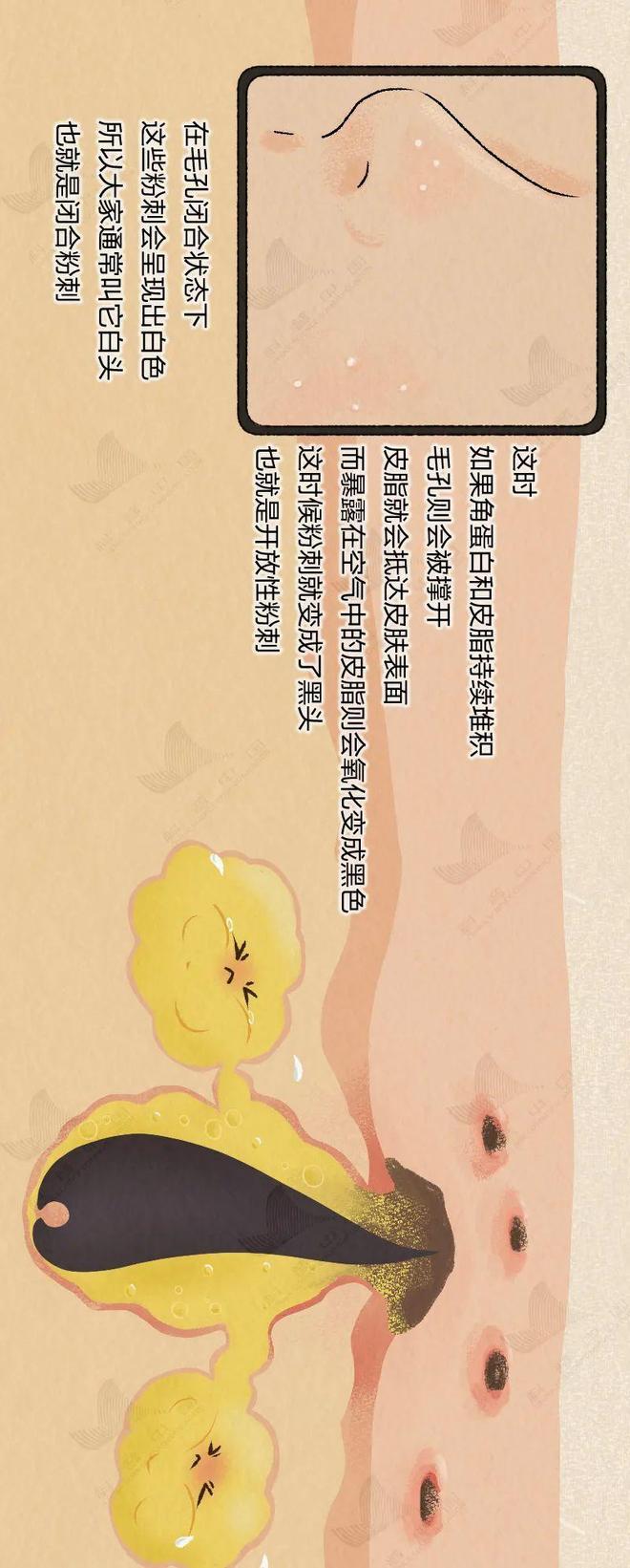 你脸上的痘痘就是这样一步步长出来的！全过程曝光